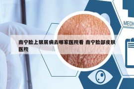 南寧臉上銀屑病去哪家醫(yī)院看 南寧臉部皮膚醫(yī)院