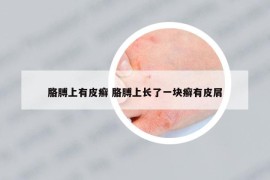 胳膊上有皮癬 胳膊上長了一塊癬有皮屑