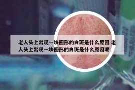 老人頭上出現(xiàn)一塊圓形的白斑是什么原因 老人頭上出現(xiàn)一塊圓形的白斑是什么原因呢