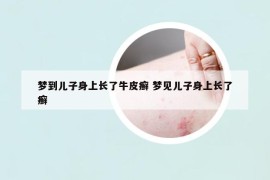 夢到兒子身上長了牛皮癬 夢見兒子身上長了癬