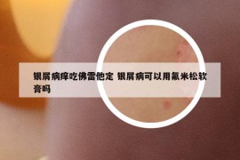 銀屑病癢吃佛雷他定 銀屑病可以用氟米松軟膏嗎
