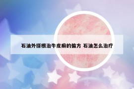 石油外搽根治牛皮癬的偏方 石油怎么治療