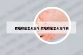膿皰癥是怎么治療 膿皰癥是怎么治療的