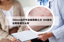 308nm治療牛皮癬需要幾次 308激光治銀屑病怎么樣