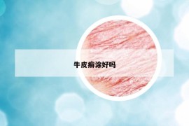 牛皮癬涂好嗎