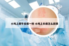 小雞上跟牛皮癬一樣 小雞上長(zhǎng)癬怎么回事