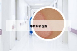 牛皮癬去醫(yī)院
