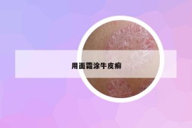 用面霜涂牛皮癬