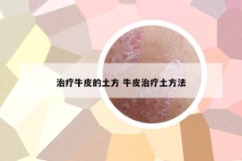 治療牛皮的土方 牛皮治療土方法