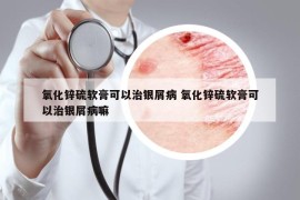 氧化鋅硫軟膏可以治銀屑病 氧化鋅硫軟膏可以治銀屑病嘛