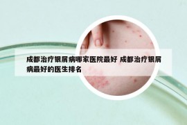成都治療銀屑病哪家醫(yī)院最好 成都治療銀屑病最好的醫(yī)生排名