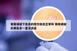 銀屑病留下色素的地方蛻皮正常嗎 銀屑病留的黑色素一直沒消退