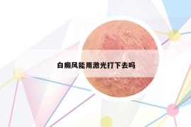 白癜風(fēng)能用激光打下去嗎