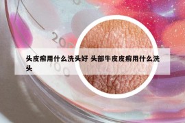 頭皮癬用什么洗頭好 頭部牛皮皮癬用什么洗頭