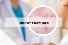 深圳市治牛皮癬的權(quán)威醫(yī)院
