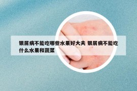 銀屑病不能吃哪些水果好大夫 銀屑病不能吃什么水果和蔬菜