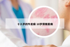 十八歲的牛皮癬 18歲得銀屑病