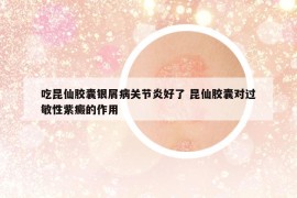 吃昆仙膠囊銀屑病關(guān)節(jié)炎好了 昆仙膠囊對過敏性紫癜的作用