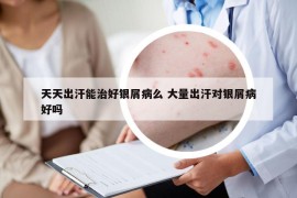 天天出汗能治好銀屑病么 大量出汗對(duì)銀屑病好嗎