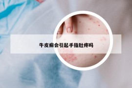 牛皮癬會(huì)引起手指肚疼嗎