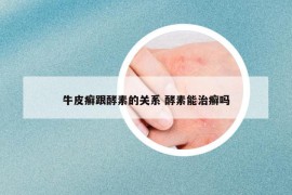 牛皮癬跟酵素的關(guān)系 酵素能治癬嗎