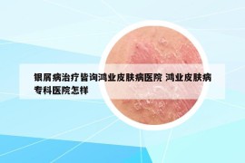 銀屑病治療皆詢鴻業(yè)皮膚病醫(yī)院 鴻業(yè)皮膚病?？漆t(yī)院怎樣