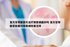 復(fù)方甘草酸苷片治療銀屑病最好嗎 復(fù)方甘草酸苷膠囊對銀屑病效果怎樣