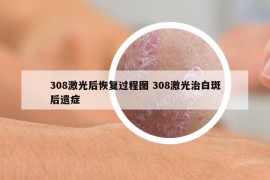 308激光后恢復(fù)過程圖 308激光治白斑后遺癥