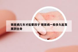 銀屑病幾年才能要孩子 銀屑病一般多久能發(fā)展到全身