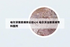 哈爾濱銀屑病祥云放心6 哈爾濱治銀屑病專科醫(yī)院