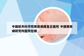 中國航天科學院銀屑病康復總醫(yī)院 中國銀屑病研究所醫(yī)院在哪