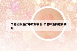 辛老團(tuán)隊(duì)治療牛皮癬真假 辛老師治褥瘡真的嗎