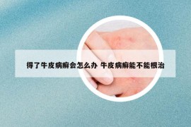 得了牛皮病癬會怎么辦 牛皮病癬能不能根治