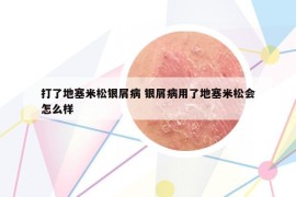 打了地塞米松銀屑病 銀屑病用了地塞米松會(huì)怎么樣