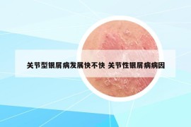 關(guān)節(jié)型銀屑病發(fā)展快不快 關(guān)節(jié)性銀屑病病因