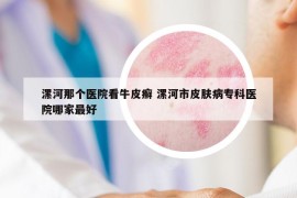 漯河那個醫(yī)院看牛皮癬 漯河市皮膚病?？漆t(yī)院哪家最好