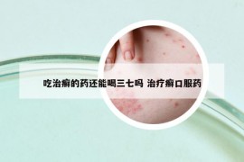 吃治癬的藥還能喝三七嗎 治療癬口服藥