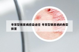 尋常型銀屑病感染途徑 尋常型銀屑病的典型損害