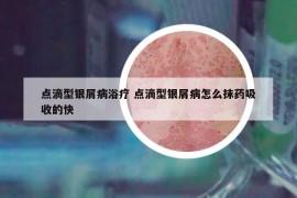 點(diǎn)滴型銀屑病浴療 點(diǎn)滴型銀屑病怎么抹藥吸收的快