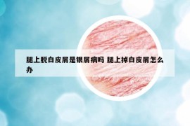 腿上脫白皮屑是銀屑病嗎 腿上掉白皮屑怎么辦
