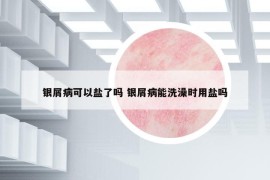 銀屑病可以鹽了嗎 銀屑病能洗澡時(shí)用鹽嗎