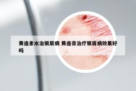 黃連素水治銀屑病 黃連膏治療銀屑病效果好嗎