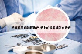 手部銀屑病如何治療 手上的銀屑病怎么治療