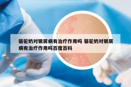 駱駝奶對銀屑病有治療作用嗎 駱駝奶對銀屑病有治療作用嗎百度百科