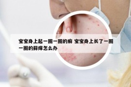 寶寶身上起一圈一圈的癬 寶寶身上長了一圈一圈的蘚癢怎么辦