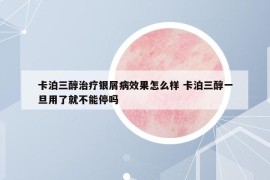 卡泊三醇治療銀屑病效果怎么樣 卡泊三醇一旦用了就不能停嗎