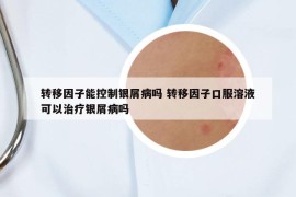 轉移因子能控制銀屑病嗎 轉移因子口服溶液可以治療銀屑病嗎