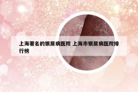 上海著名的銀屑病醫(yī)院 上海市銀屑病醫(yī)院排行榜