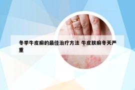 冬季牛皮癬的最佳治療方法 牛皮膚癬冬天嚴(yán)重