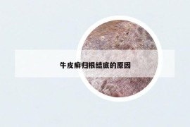 牛皮癬歸根結(jié)底的原因